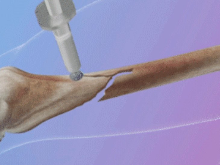 تین منٹ میں ہڈی جوڑنے والی گلو ایجاد، سرجری کی دنیا میں انقلاب