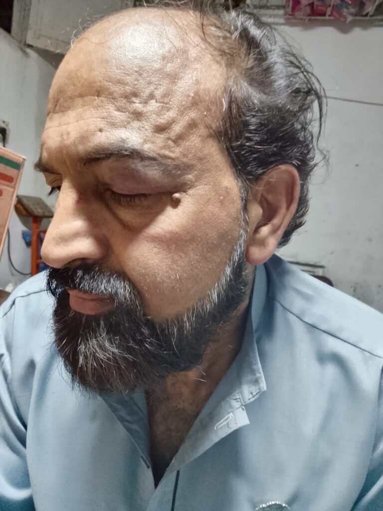 خبریں شائع کرنے کی رنجش افغانی پٹھانوں کا مری کے سنیر صحافی راشد مغل پر حملہ